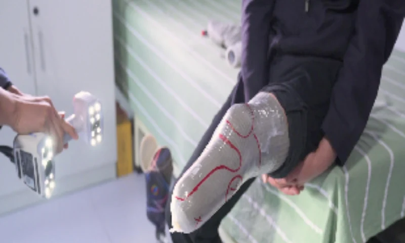 EinScan H2 capturing a marked prosthetic leg socket for orthotics and prosthetics fabrication